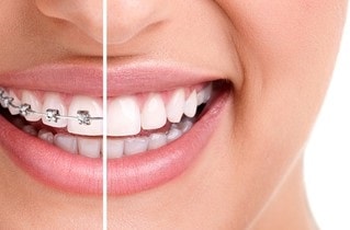 Straightening Teeth